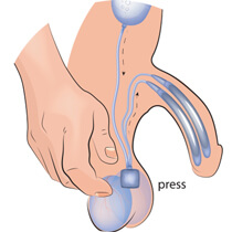 Penile implant, how it works 01