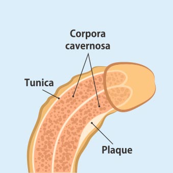 Peyronies disease 01, ED Clinic Gold Coast